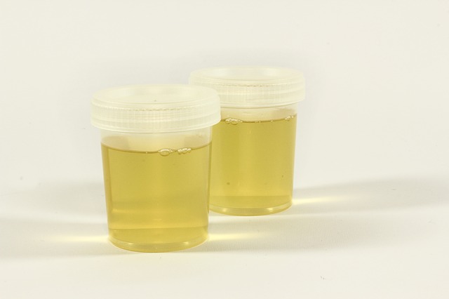 Koncetracija urina i piurija za utvrđivanje dijagnoze infekcije urinarnog trakta kod odojčadi