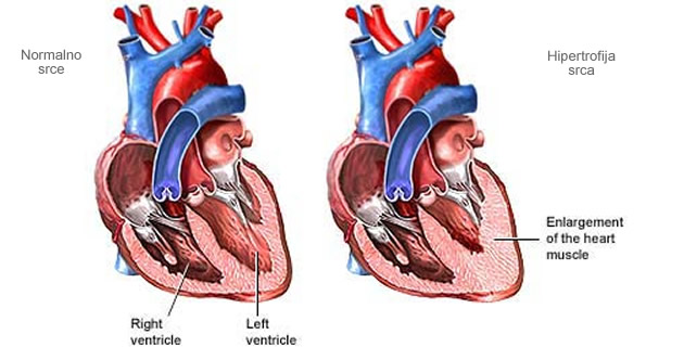 Modifikovana klasifikacija hipertrofije leve komore radi obezbeđivanja novog uvida u progresiju iz hipertenzije do srčane insuficijencije