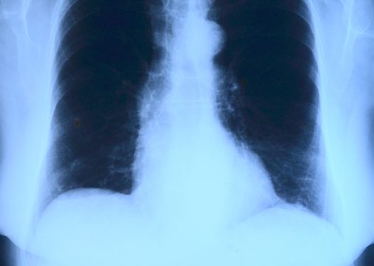 Srbija – zemlja sa niskim opterećenjem tuberkulozom