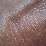 Upotreba hidrohlortiazida i rizik od nemelanomskog raka kože: studija slučaja iz Danske