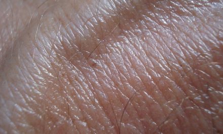 Upotreba hidrohlortiazida i rizik od nemelanomskog raka kože: studija slučaja iz Danske